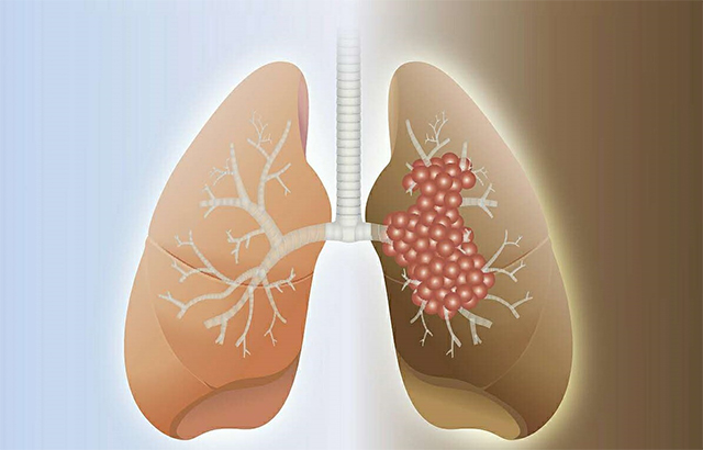 中医如何对肺肿瘤进行分型？如何“对型治疗”？