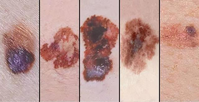 黑色素瘤是一种什么病？