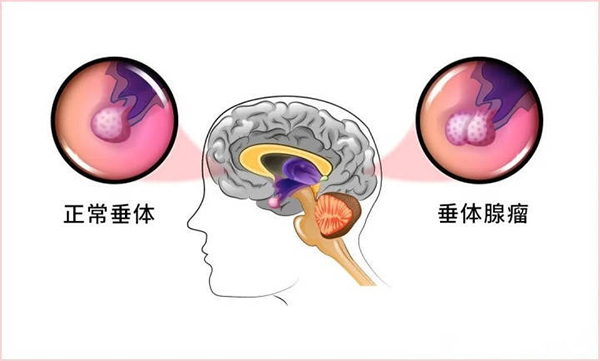 脑垂体瘤是一种怎样的病?