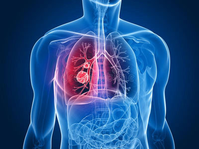 中医治肺瘤的关键及治则