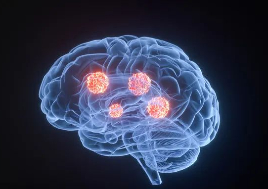 为什么肿瘤细胞喜欢脑转移？脑转移都有哪些信号呢？