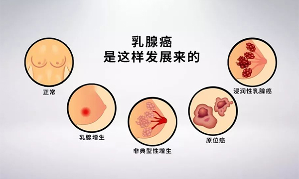 乳腺瘤发现时易是晚期肿瘤？哪些肿瘤不易早期发现？