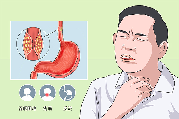 食管瘤肺转移咳嗽明显吗？肿瘤晚期病人会出现哪些不良状况？