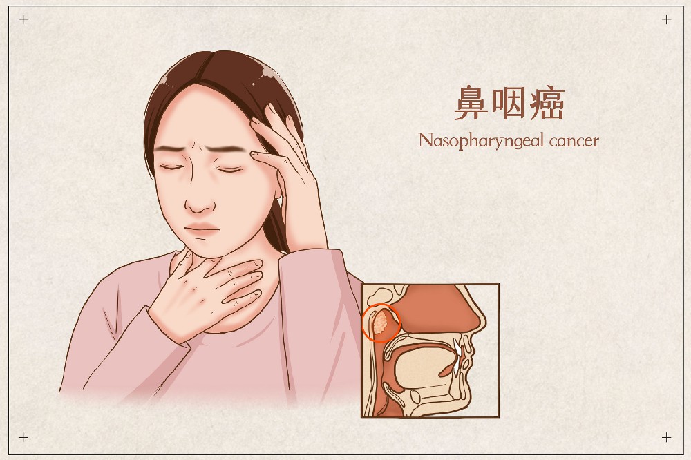 出现这些症状，要警惕是鼻咽癌！